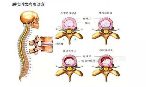 腰椎间盘突出症和马尾神经综合征有哪些关系?