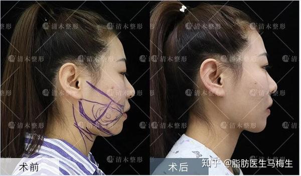 形成双下巴的原因以及解决方法