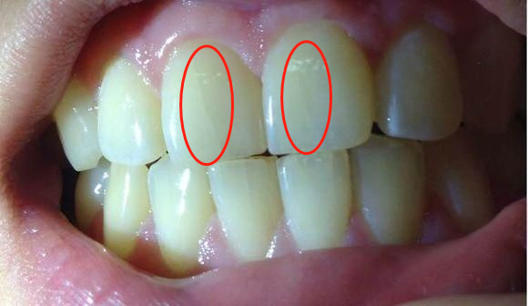 常说的"牙齿裂纹",医学上称之为"牙隐裂",又称"
