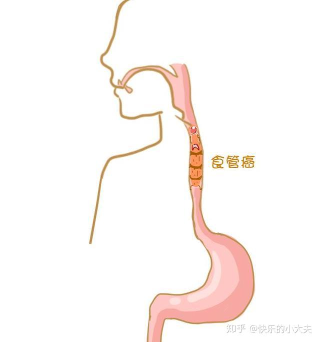 爱吃热的得了食道癌?医生提醒:4个症状一定就医,7项措施来预防