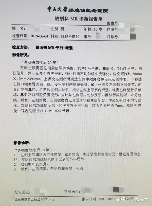 病例分享丨鼻咽癌放疗诱导的左上颌颅底骨肉瘤