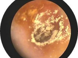 人外耳道耵聍腺的分泌物被称为耵聍,也被称为"耳垢"耳屎.