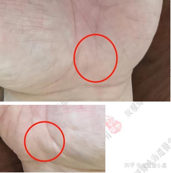建议 病患者问诊时的问题,脂肪肝,痛风,腰腿疼痛尤其是手脚区.