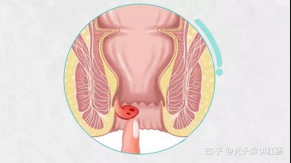 重庆肛肠医院:内痔"肉球"怎么收回去呢?