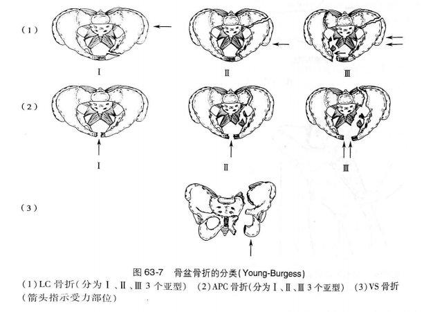 骨盆髋臼骨折笔记