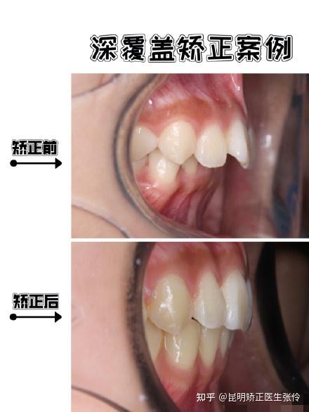 深覆盖深覆合如何矫正能达到咬合正常呢