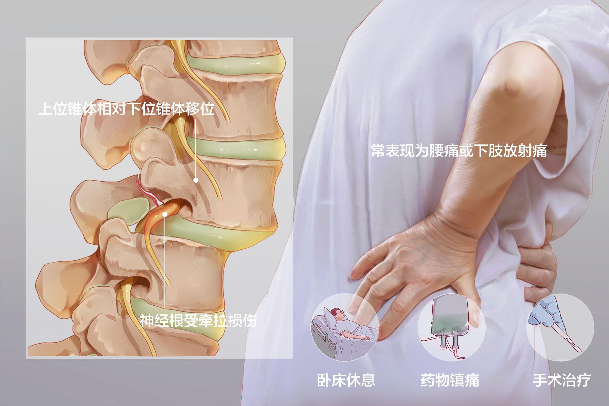 肥胖会引起腰椎滑脱度增加吗?