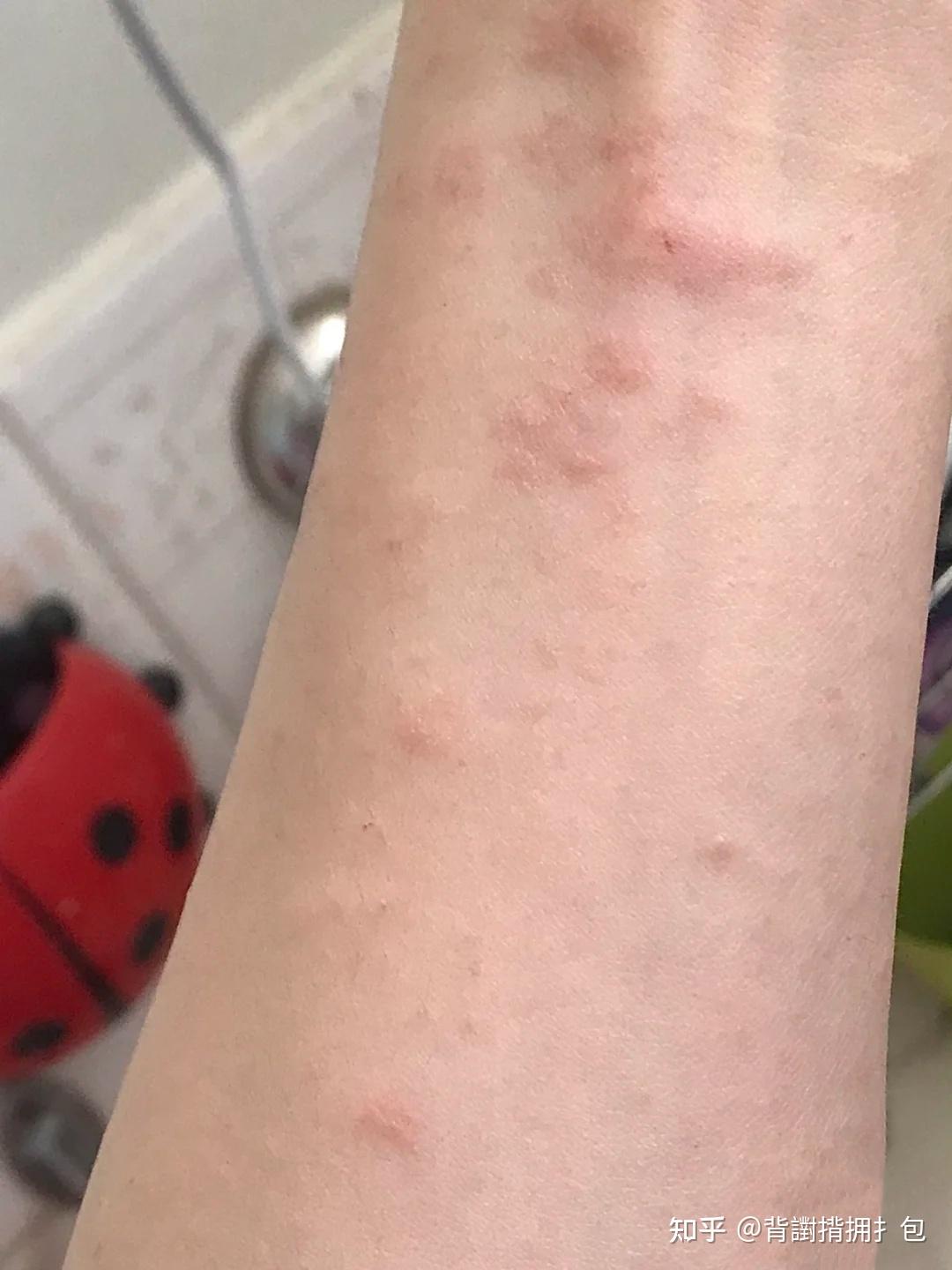 腿上长湿疹怎么办