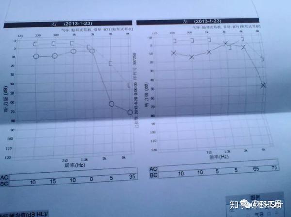 必须进行调岗处理;而且要重点关注电测听,就是纯音听阈测试的结果