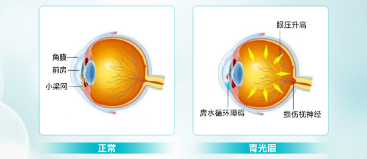 什么是青光眼 甚至认为青光眼可以治好 那么,事实又是怎样呢?