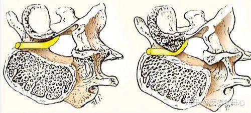 什么是侧隐窝型椎管狭窄