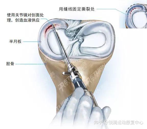 关节镜下半月板撕裂缝合示意图