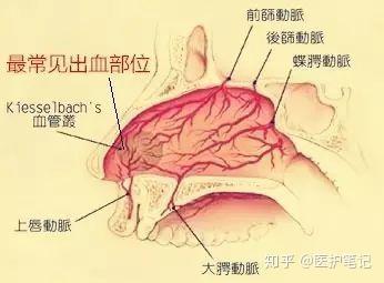 其实儿童鼻出血部位大部分是位于鼻中隔前下方的黎氏区,所以最简单