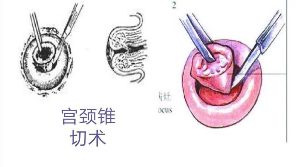 医生,精通手术室段子,略懂各类妇科疾病 宫颈癌是常见的妇科恶性肿瘤