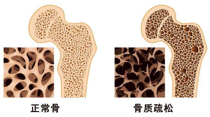 世界骨质疏松日糖友不要忽视这个沉默杀手