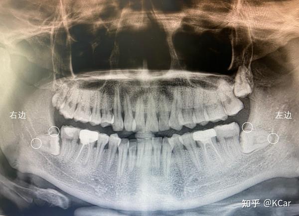 9年前(21岁)因为治疗蛀牙去私人牙医诊所拍了x光片,当时就已经
