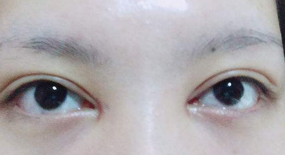 南华博士:什么是开眼角?开了容易留疤吗?