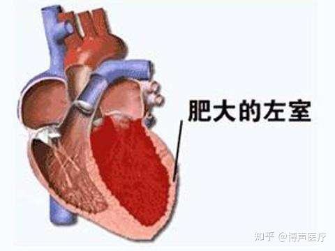 博声医疗左心室肥大左心室肥大的原因