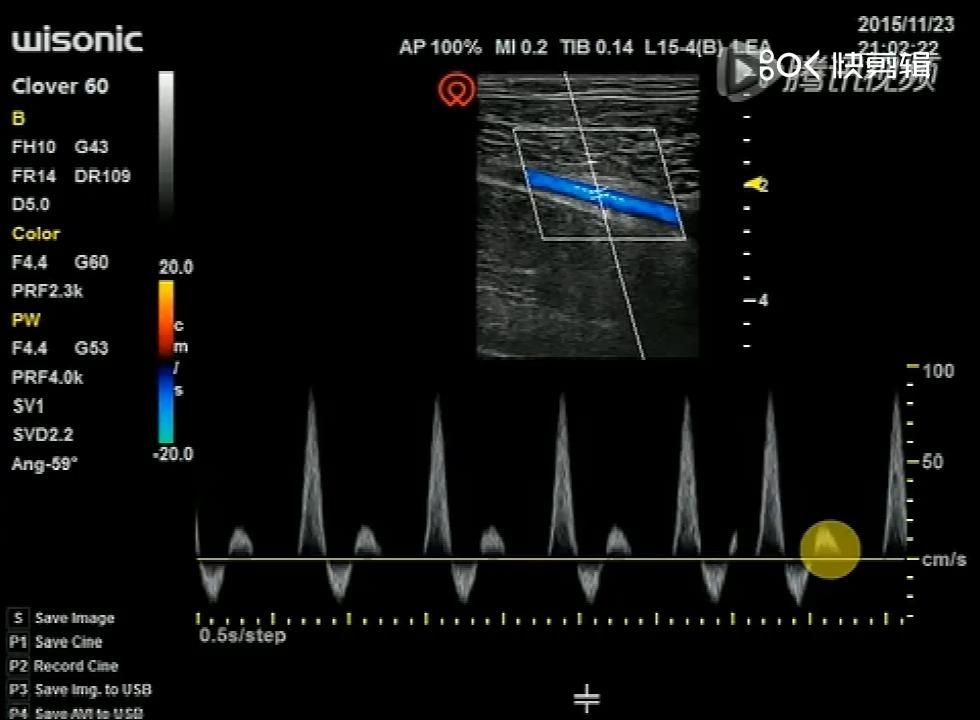 需要播放声音来辅助诊断的只有频谱多普勒模式,可能是脉冲多普勒(pwd)