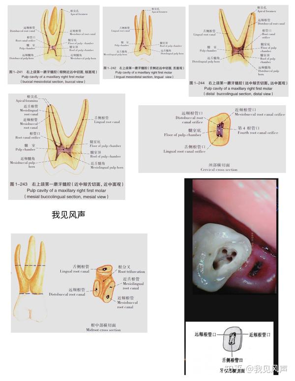 图片|上下6形态及根管口位置