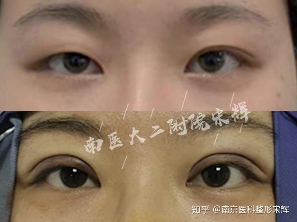 南京宋辉双眼皮案例分享