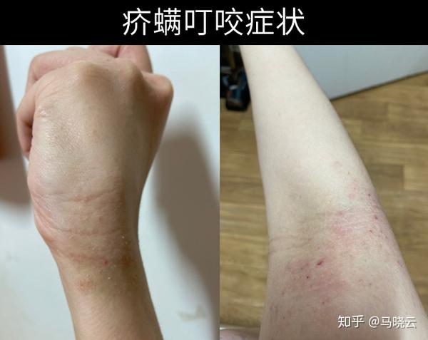 人身上被螨虫咬的图片?螨虫怎么去除?