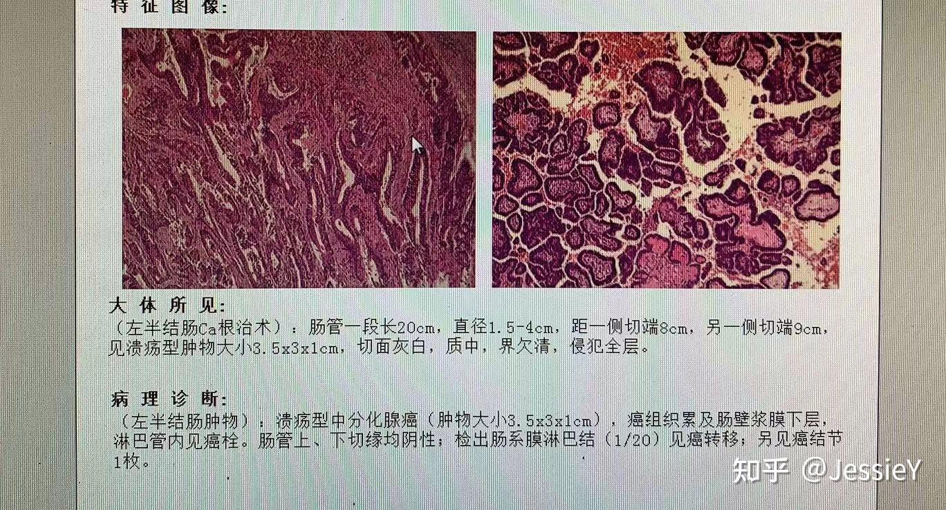 8 询问病理报告,显示为:左半结肠 溃疡型中分化腺癌,术后pt3n1m0,iiic