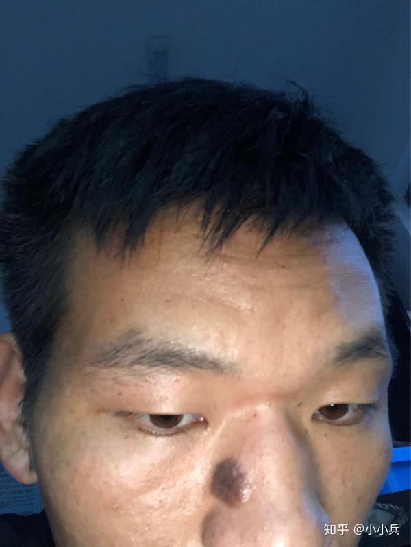 鼻子上有一个特大的黑色素痣,能做掉吗?