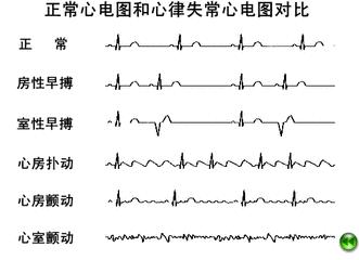 心脏不难受为什么还要去查心电图心电图不是你想象的那么简单