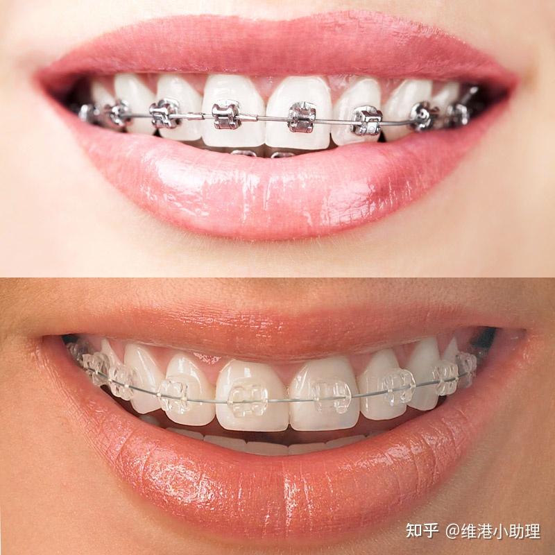 深圳牙齿矫正医生科普丨不同牙齿矫正器的区别丨传统金属vs金属自锁丨