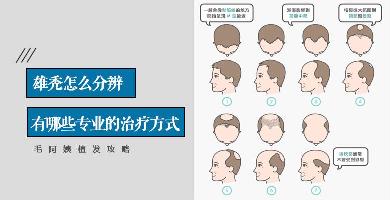 不同时期的雄秃怎么分辨?有哪些专业科学的治疗方法?