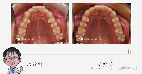 骨性错颌畸形只能通过手术治疗,单纯正畸治疗可以嘛?