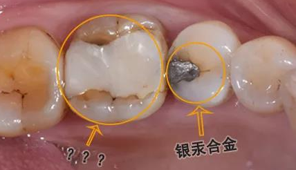 治疗虫牙补牙和根管治疗之间有什么区别