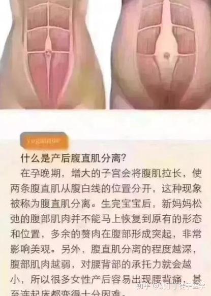 腹直肌修复,骨盆修复,盆底肌修复之间的关系,你一定要