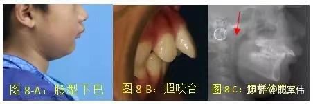 位置情况,如发现有影响咀嚼的干扰因素,需要及时纠正,如个别后牙反合