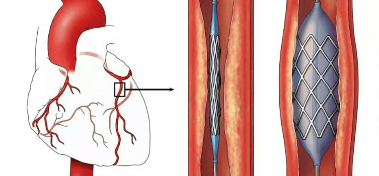 做完心脏支架手术后应该吃什么药要吃多久的药