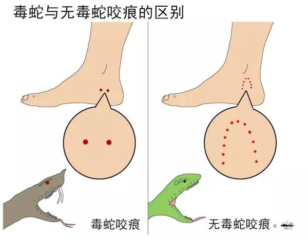 被蛇咬了怎么办?