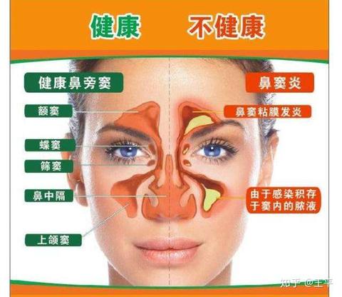 根治鼻炎咽炎不用药