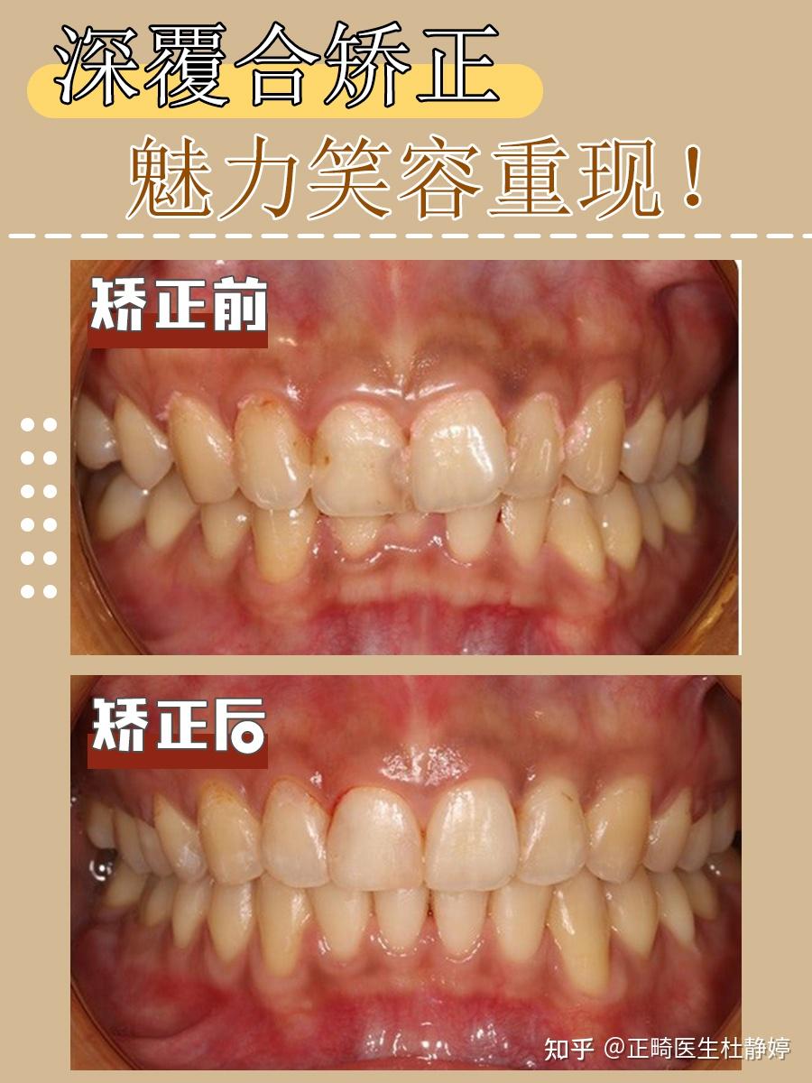 深覆合金属矫正案例