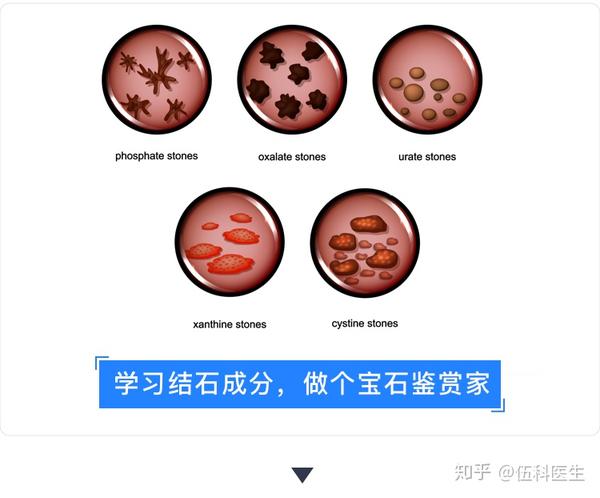 琳琅满目看看你身体里的肾结石长啥样