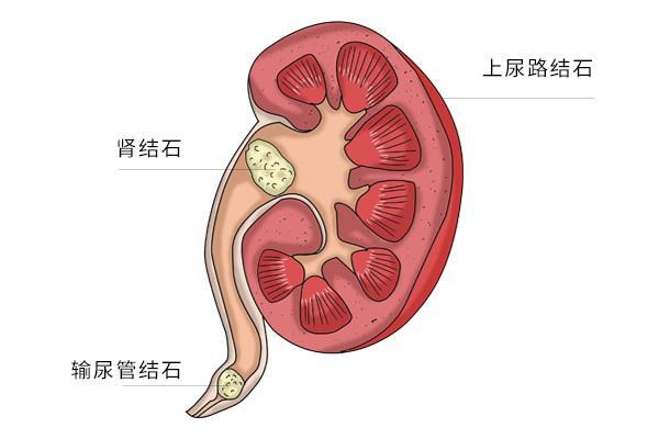 腰酸说明肾结石已长大肾结石竟会引发尿毒症