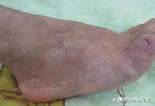 为什么有些类型的血管瘤会疼痛?