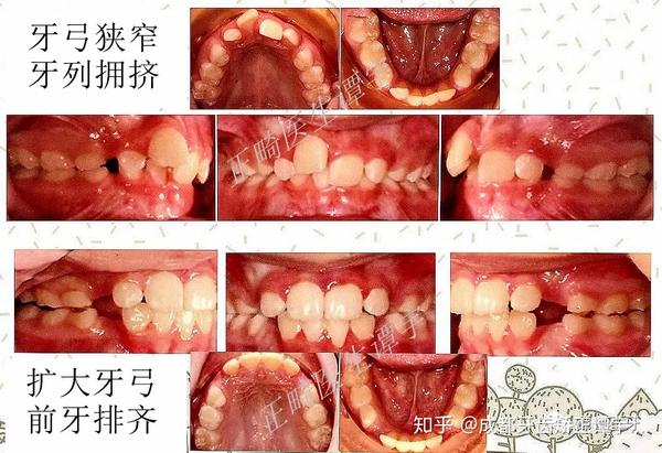 我认为这个时期理想的矫治器应具有以下优点:对各种牙颌畸形都有效