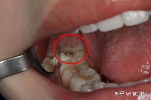 男子的脸都被智齿"捅破"!