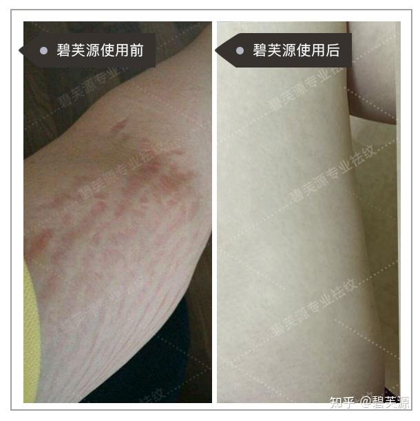 救命 男173体重120 膝盖长这个是肥胖纹还是生长纹?