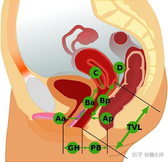 0度的子宫脱垂是不需要做治疗.
