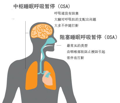 中枢性睡眠呼吸暂停csa症状原因和治疗方案