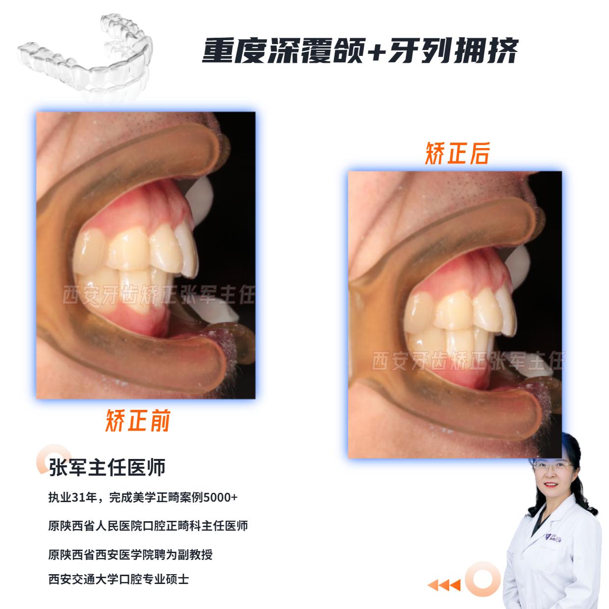 西安牙齿矫正重度深覆颌是前牙牙槽骨高度过大而后牙牙槽骨高度不足