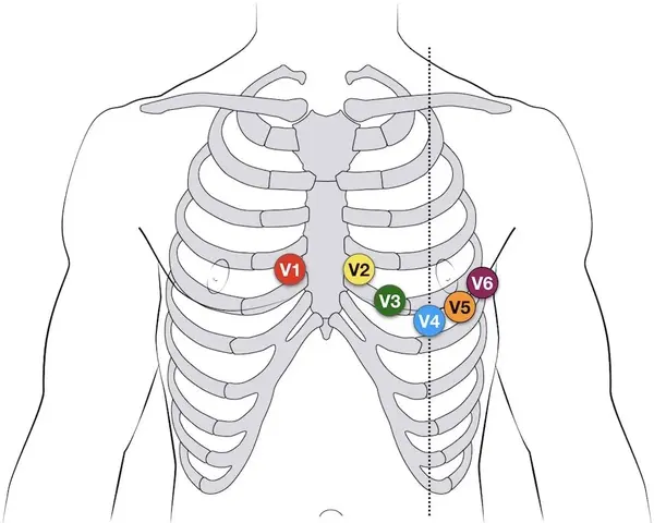 胸导联v1-v6的位置