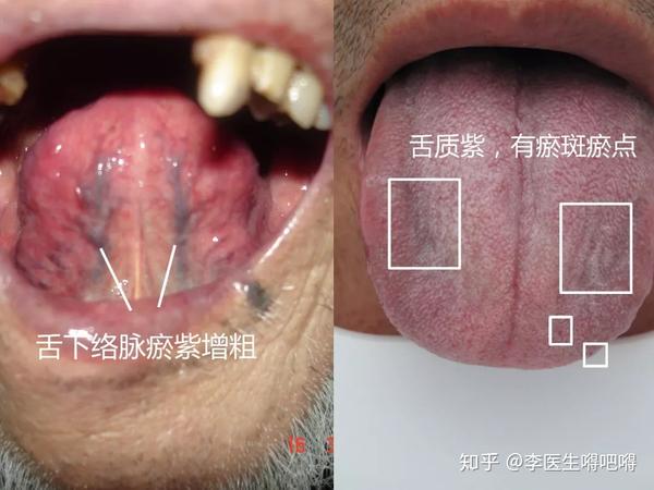 舌质多呈现瘀紫,有瘀斑瘀点和舌下络脉瘀紫增粗.